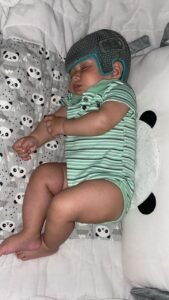 bebê sorrindo usando órtese craniana 3D azul na Clínica Baby Helmet