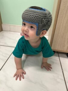 tratamento-assimetria-craniana-com-ortese-3-d