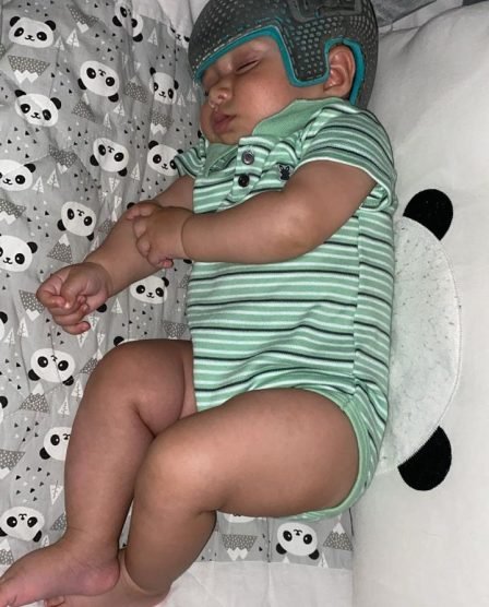 bebê sorrindo usando órtese craniana 3D azul na Clínica Baby Helmet