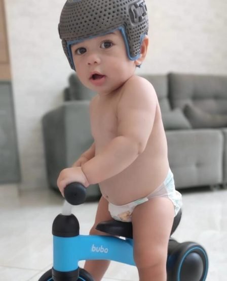tratamento de assimetrias cranianas com órtese 3D